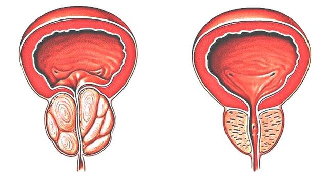 Prostatitis i normalna prostata