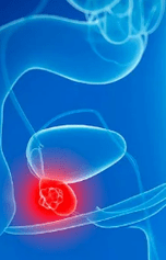 Prostatis