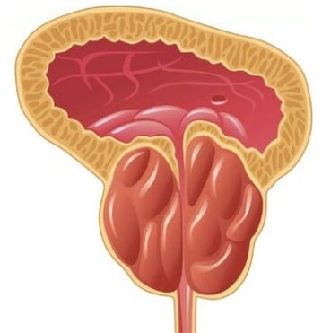 Upala prostate