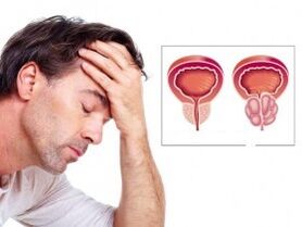 Prostatitis u čovjeku