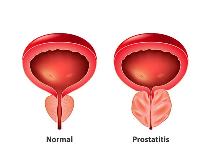 Normalna i upalna prostata
