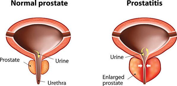 Normalna i upaljena prostata