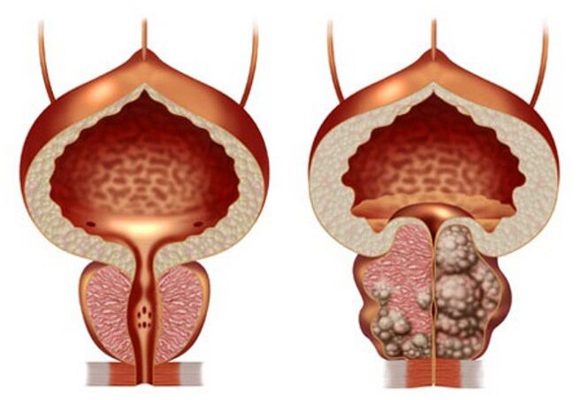 zdrava prostata i adenom prostate
