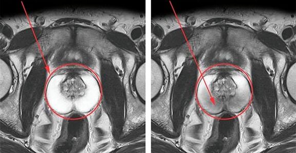 Normalna prostata (lijevo) i upala prostate s prostatitisom (desno)